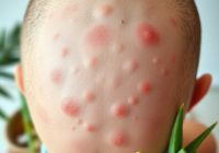 Trądzik głowy – przyczyny, objawy, leczenie i domowe sposoby działania