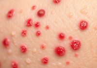 Jak rozpoznać trądzik grzybiczy? Objawy i leczenie skórne