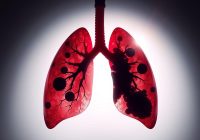 Rak płuca – przyczyny, objawy i metody leczenia nowotworu