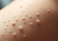 Rogowacenie okołomieszkowe – przyczyny, objawy i metody leczenia