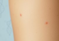 Przyczyny rozstępów – hormony, geny i wpływ masy ciała