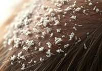 Łupież: przyczyny, objawy i skuteczne metody leczenia Łupież: przyczyny, objawy i skuteczne metody leczenia